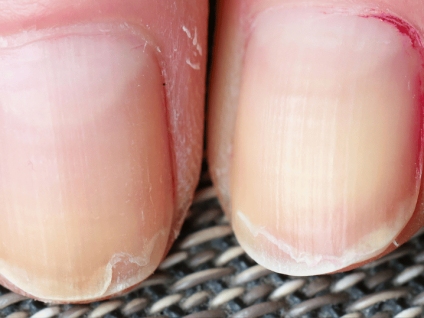 Pourquoi vos ongles se dédoublent (et comment y remédier durablement)